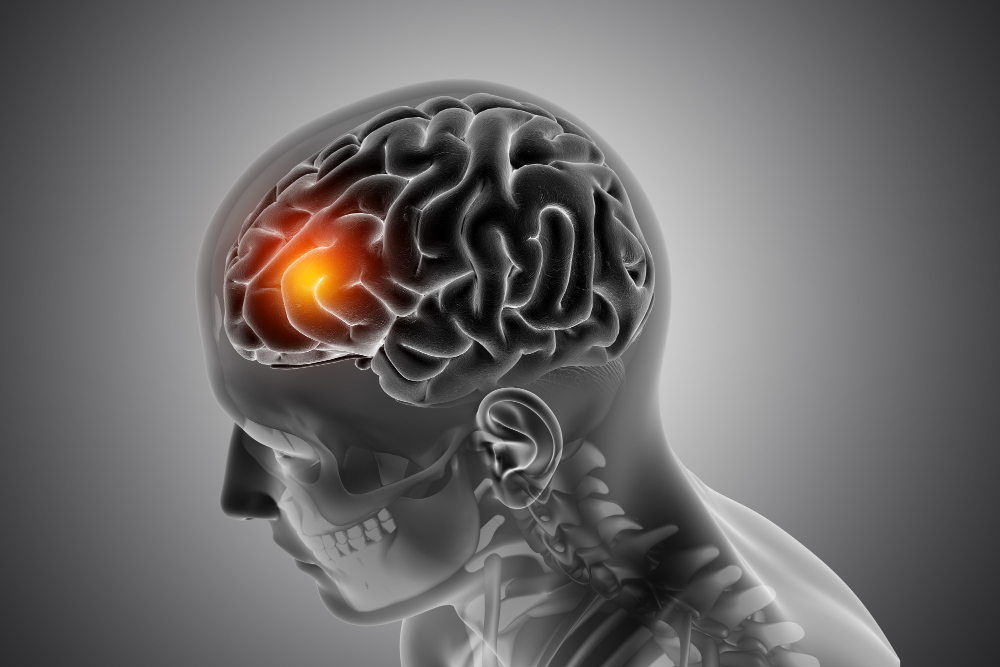 Traumatic Brain Injuries